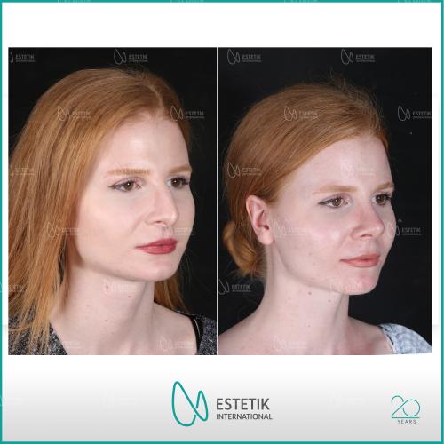 Septoplasty Before / After photo