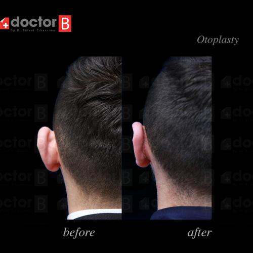 Chirurgie des oreilles décollées (Otoplastie) Photos avant & après