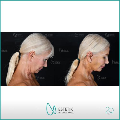 Chin augmentation Before / After photo