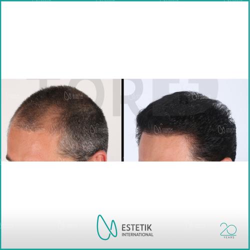 PRP for Hair Loss Before / After photo