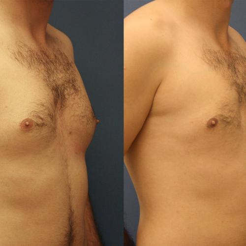 fotos antes y después de nuestros pacientes - Cirugía de lifting de cuerpo completo - Dr. Çağatay Güngörsün
