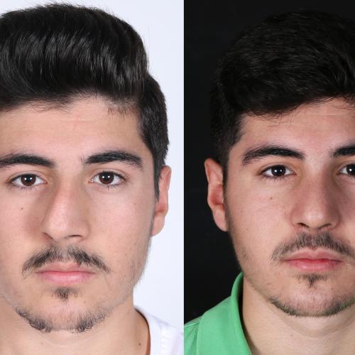 عملية تجميل الأنف صور قبل وبعد
