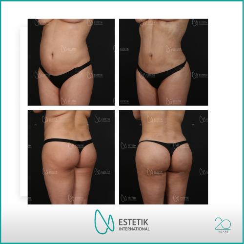 fotos antes y después de nuestros pacientes - Cirugía Estética - Dr. Çağatay Güngörsün