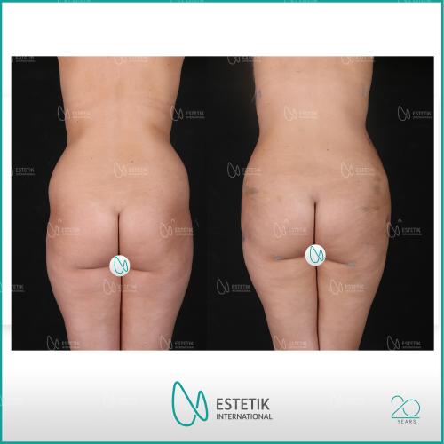 صور قبل وبعد لمرضانا - الجراحة التجميلية - د. مرفة أوفلاز