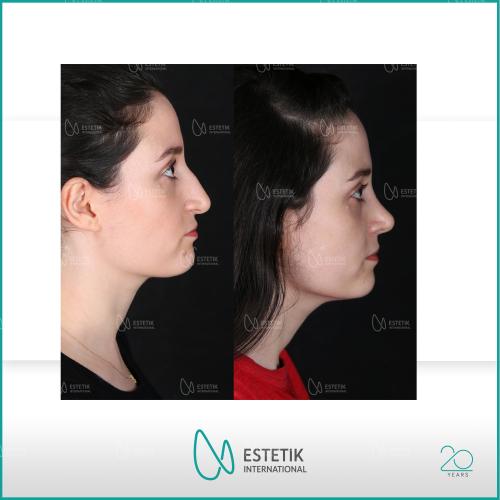 Rinoplastia ultrasónica Fotos del antes y el después