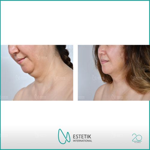 Chin augmentation Before / After photo