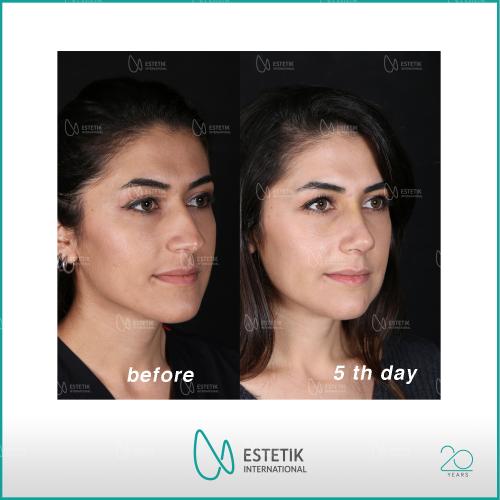 Septoplasty Before / After photo