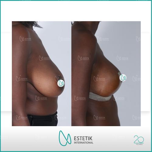 الجراحة التجميلية صور قبل وبعد