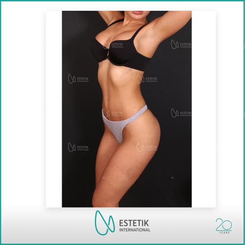fotos antes y después de nuestros pacientes - Liposucción Láser - Dr. Çağatay Güngörsün