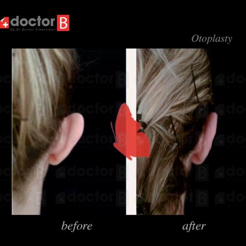 Chirurgie des oreilles décollées (Otoplastie) Photos avant & après