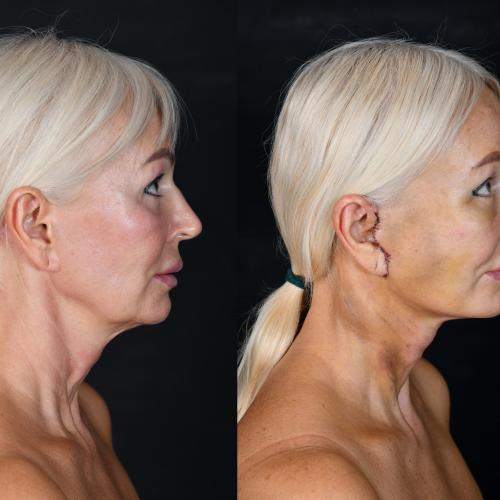 Chin augmentation Before / After photo