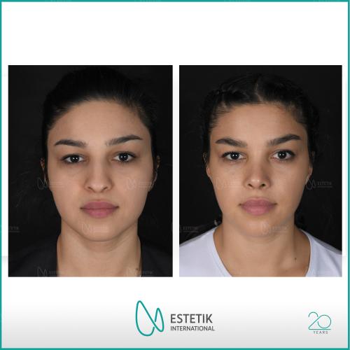 fotos antes y después de nuestros pacientes 1