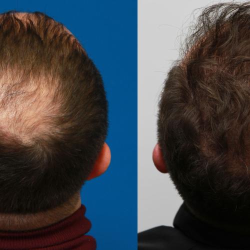 fotos antes y después de nuestros pacientes 5