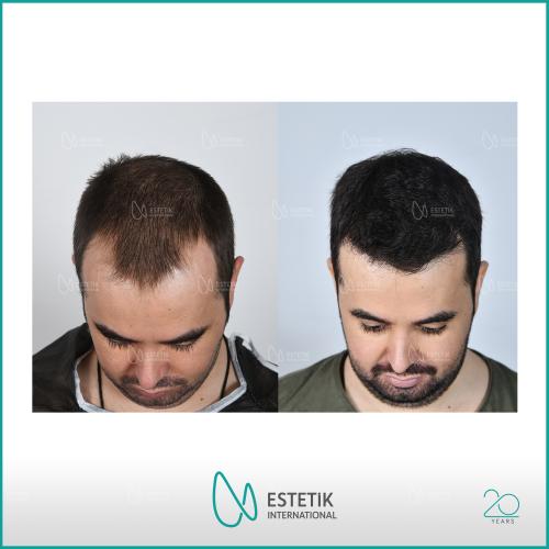 PRP for Hair Loss Before / After photo