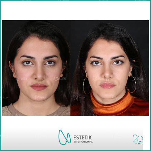 Septoplasty Before / After photo
