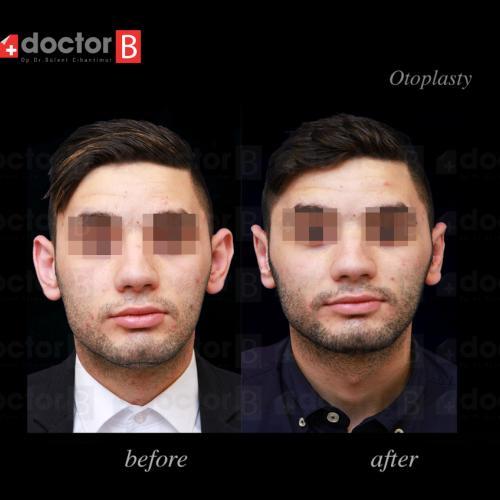 Chirurgie des oreilles décollées (Otoplastie) Photos avant & après