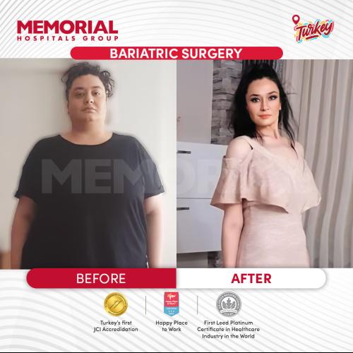 Шунтирование желудка Фотографии до и после