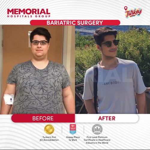 Шунтирование желудка Фотографии до и после