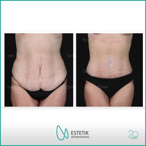 Liposucción Láser Foto antes/después