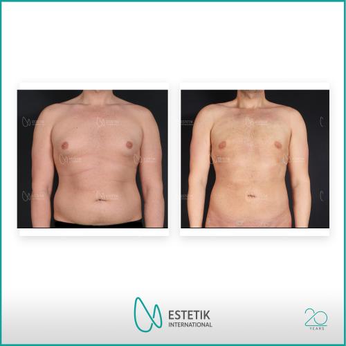 Liposucción Láser Foto antes/después