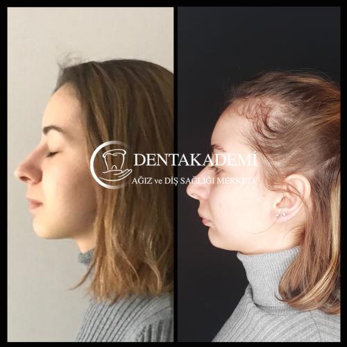 Genioplastia Foto antes/después
