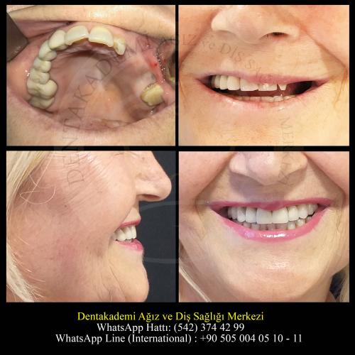Dental bridge Before / After photo