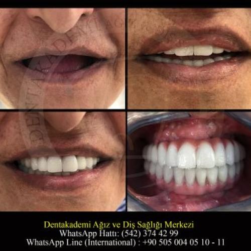 Implante dental Fotos del antes y el después