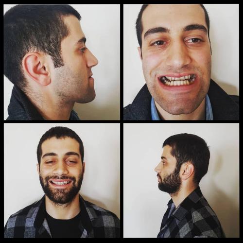 Genioplastia Foto antes/después