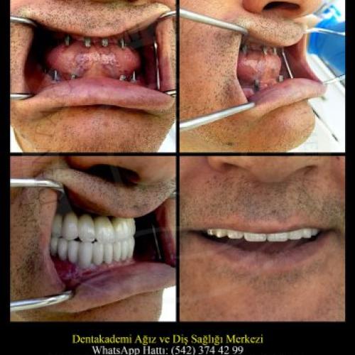 Implante dental Foto antes/después