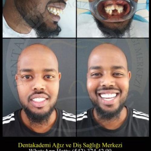  استشارة في طب الأسنان صور ماقبل / ما بعد