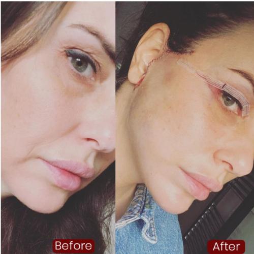 تقنية ذيل الحصان صور قبل وبعد