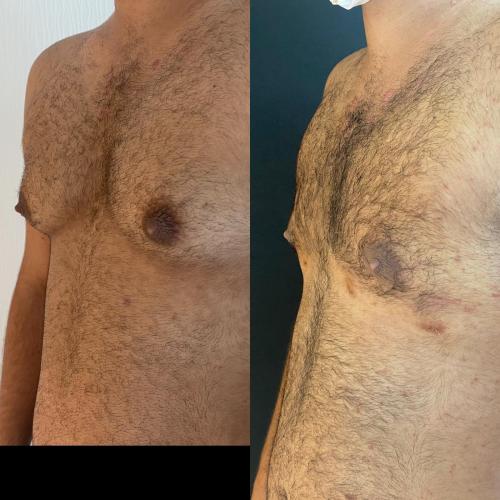 Tratamiento de ginecomastia (con liposucción) Foto antes/después