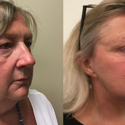 Lip filler Before / After photo