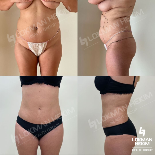 Arm lift Before / After photo