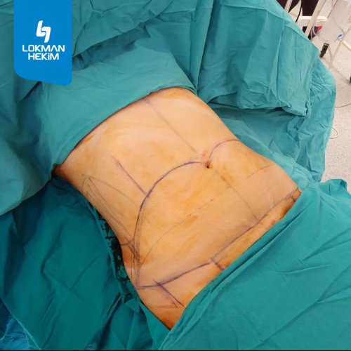 Liposucción Foto antes/después