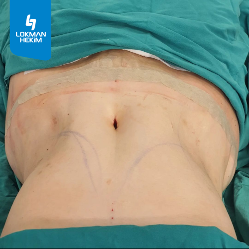 Liposucción Foto antes/después