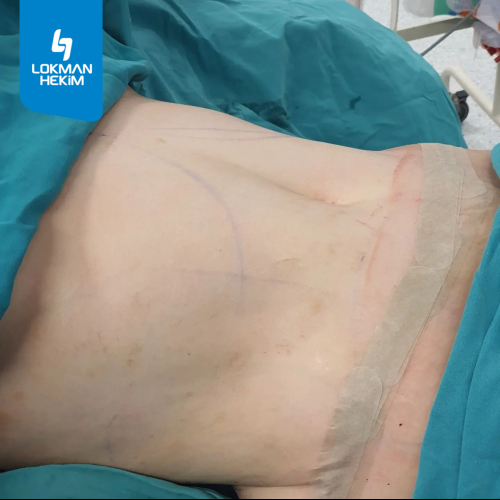 Abdominoplastie Photos avant & après