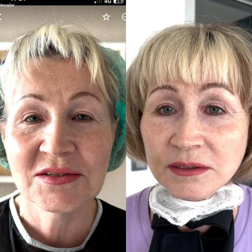 Thread lift Before / After photo