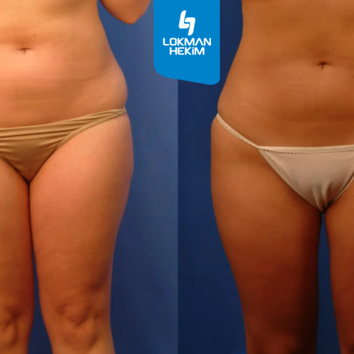 Liposucción Foto antes/después