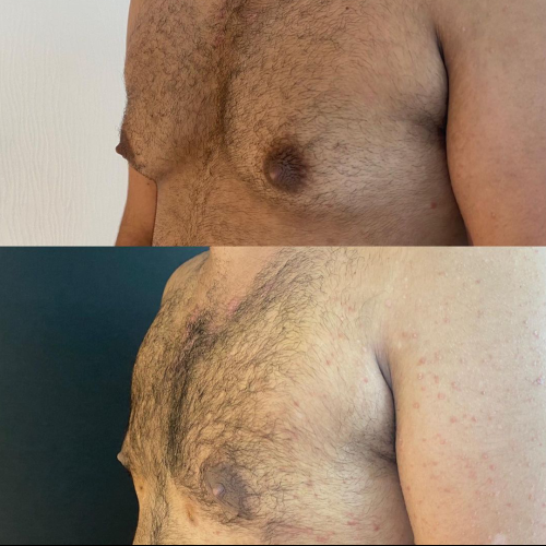 Pubic liposuction Before / After photo