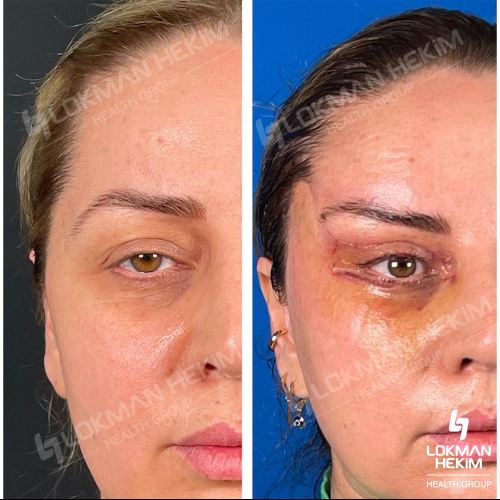 Genioplastia Foto antes/después