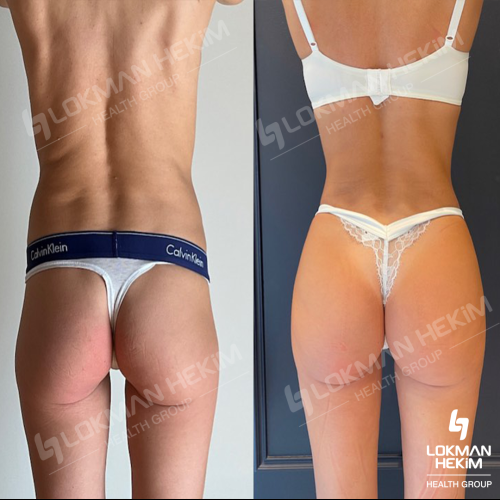 Cirugía del lipoedema Foto antes/después