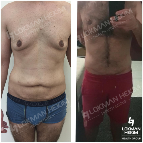 Arm lift Before / After photo