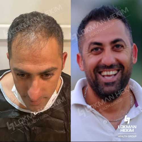 Trasplante de barba Foto antes/después