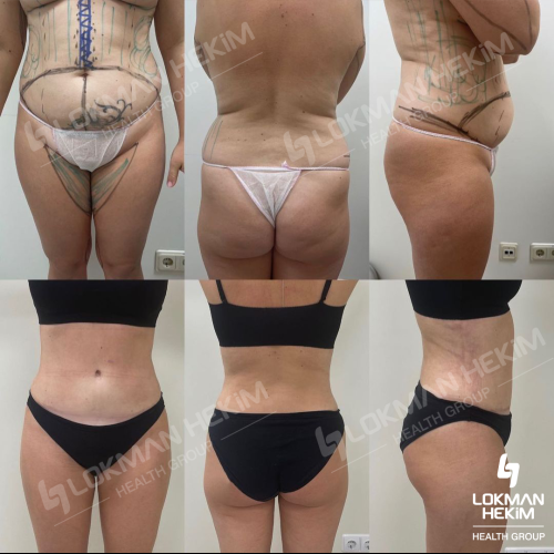 Thigh lift Before / After photo