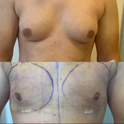 Pubic liposuction Before / After photo