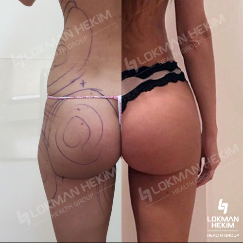 Thigh lift Before / After photo