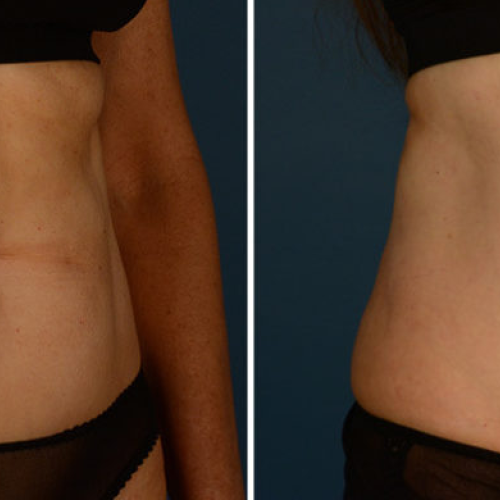 Liposucción Foto antes/después