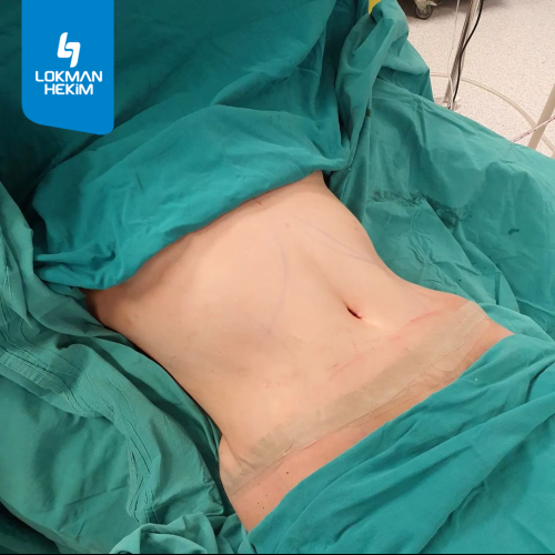 Liposucción Foto antes/después