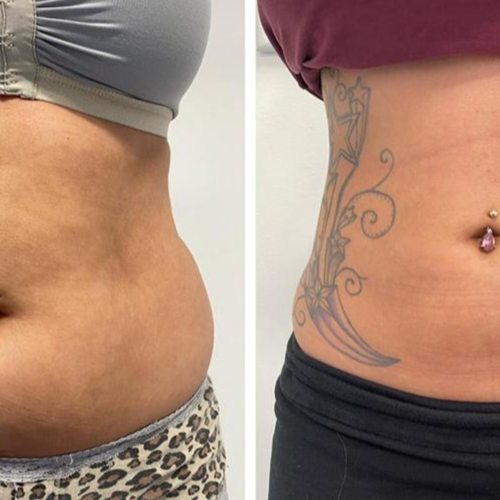 Liposucción Foto antes/después